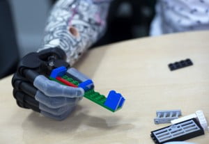 9 yasinda cocuga biyonik kol 2