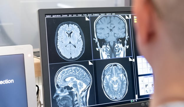 Alzheimer tanısında yeni bir adım atıldı