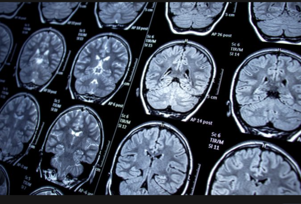 Uzun Covid atlatanların ortak sorunu ortaya çıktı